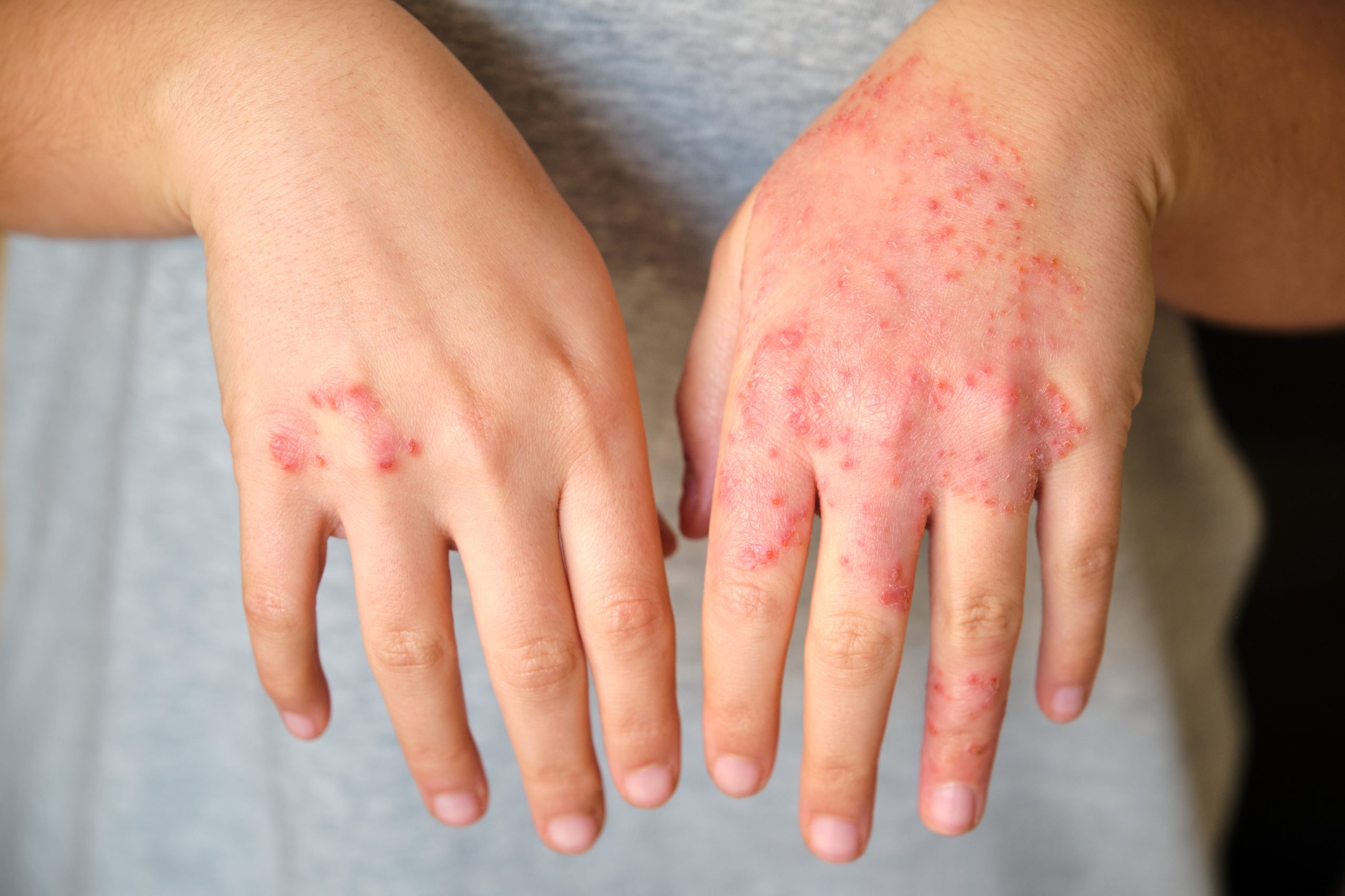gentle skincare for eczema and acne-prone skin