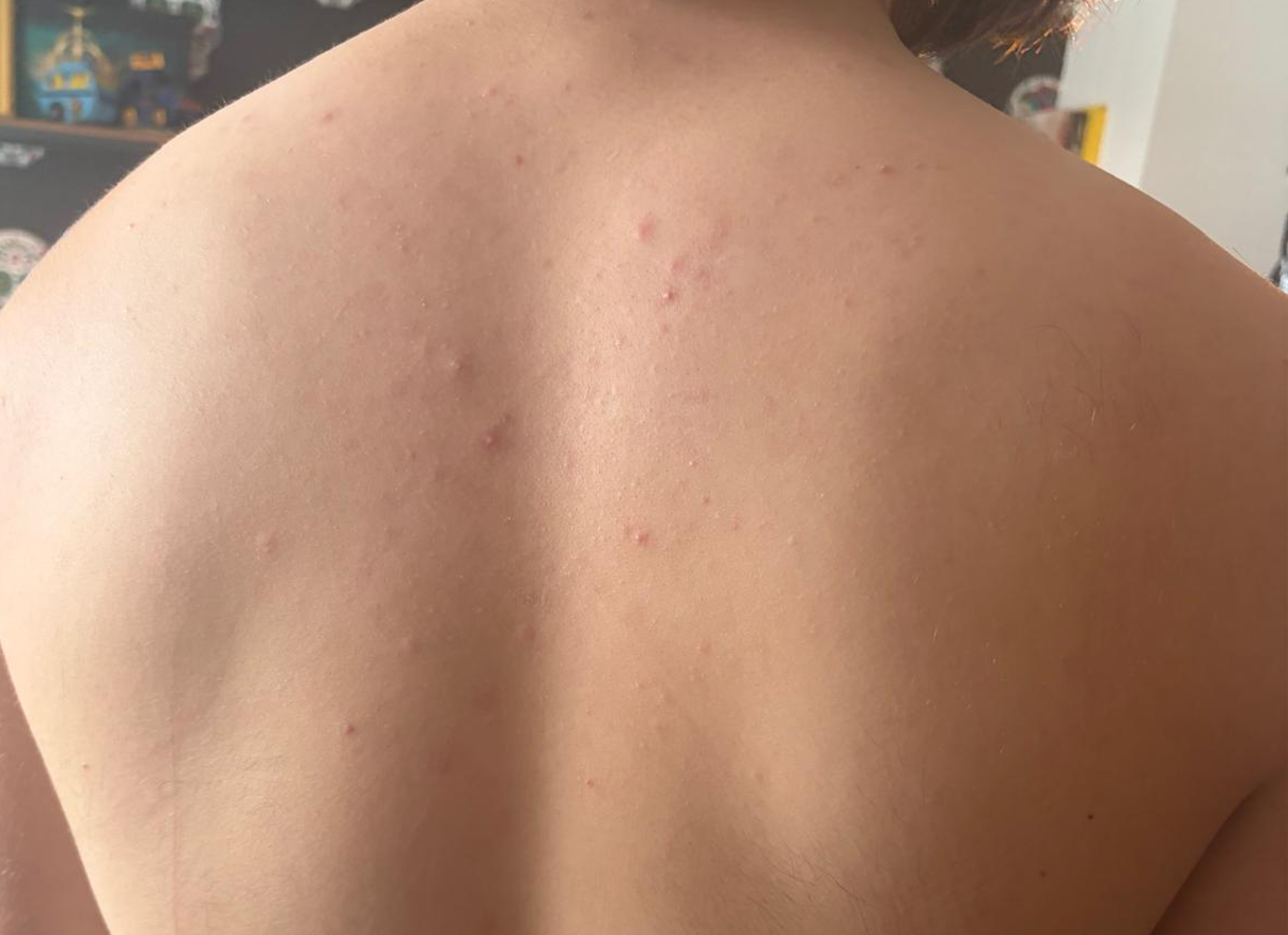 Skin on day 7 after using NBOA Acne-Prone Cleanser