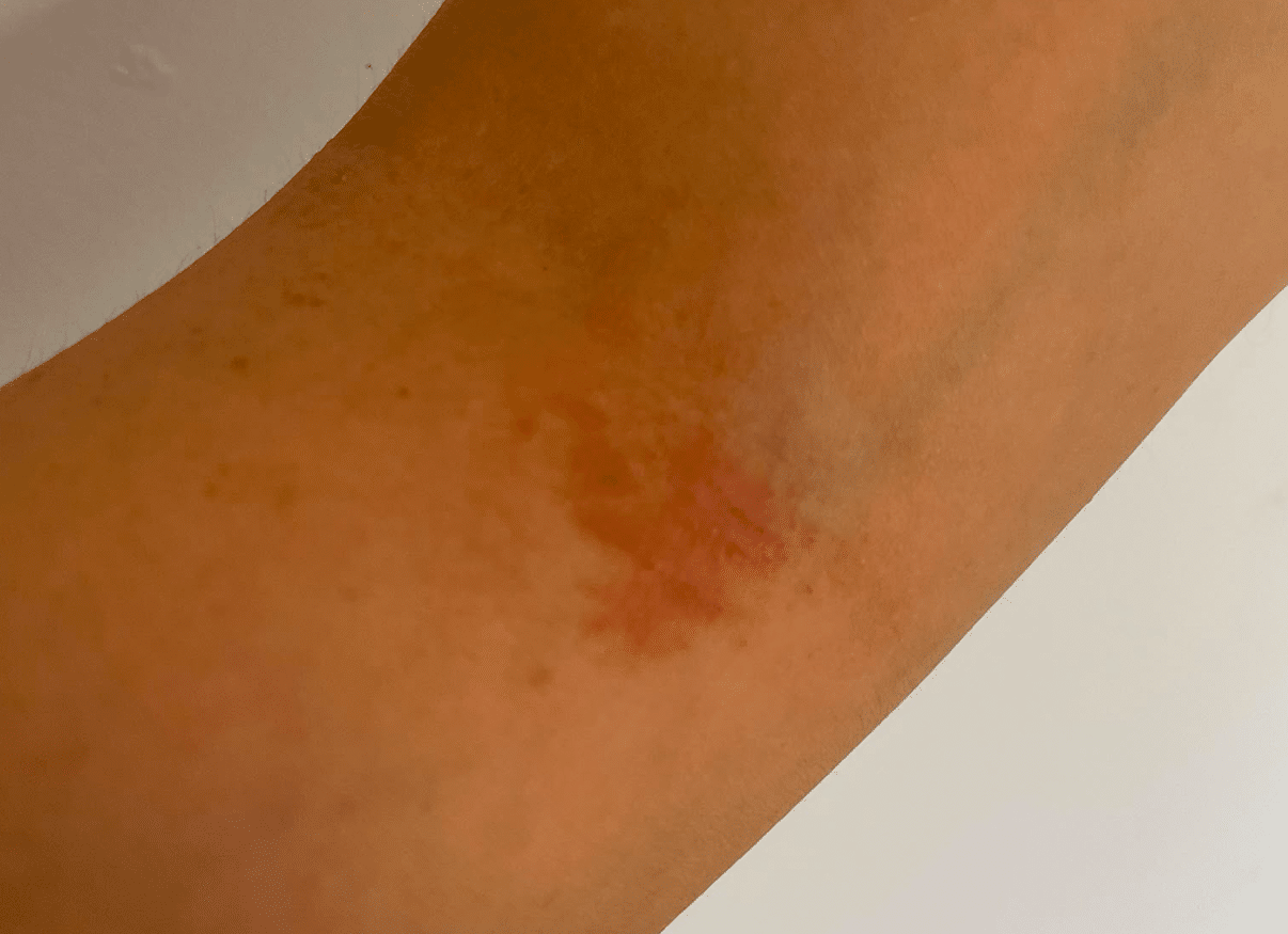 Skin on day 1 before using NBOA Eczema-Prone Moisturiser