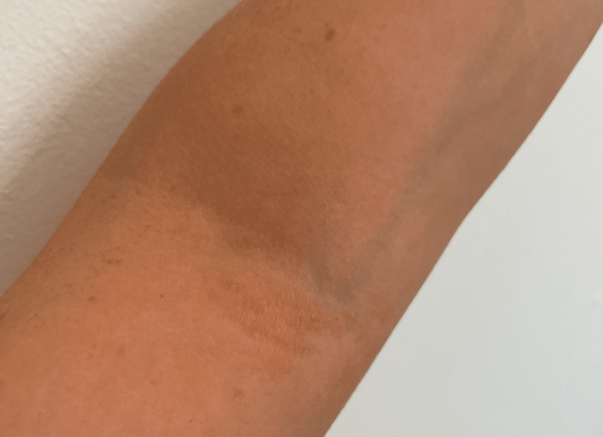 Skin on day 3 after using NBOA Eczema-Prone Moisturiser